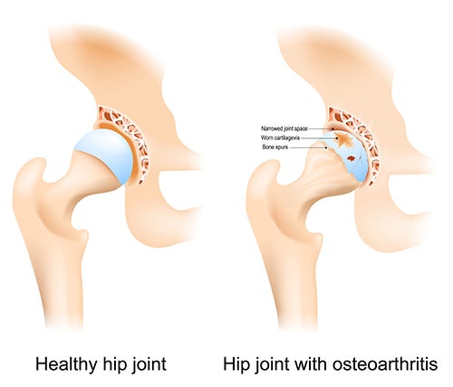 A diagram of a hip jointDescription automatically generated